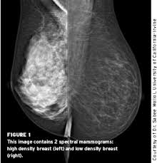 Inflammatory breast carcinoma is a rare type of invasive ductal carcinoma, which mimics an infection or mastitis at presentation. Spectral Mammography The New Color Of Breast Cancer Diagnosis Cancer Therapy Advisor