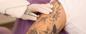 Usually 6 to 12 sessions are required to get laser tattoo removal results, normally scheduled 6 to 8 weeks apart. Things You Didn T Know About Laser Tattoo Removal Vodex Ltd