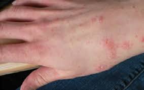 E dignostico de sospecha de sarna lo puede realizar un medico con la exploracion fisica y la consulta medica habitual. Cdc Scabies Fact Sheet
