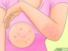 يعد الجرب أحد الأمراض الجلدية شديدة العدوى. ÙƒÙŠÙÙŠØ© Ø¹Ù„Ø§Ø¬ Ø§Ù„Ø¬Ø±Ø¨ 15 Ø®Ø·ÙˆØ© ØµÙˆØ± ØªÙˆØ¶ÙŠØ­ÙŠØ© Wikihow