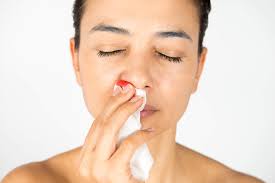 Most nosebleeds stop by themselves within a few minutes. What You Need To Know About Nosebleeds