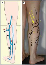 We did not find results for: Specific Criteria Of The Transcutaneous Doppler Ultrasound In Unusual Causes Of Lower Limb Varicose Veins Servier Phlebolymphologyservier Phlebolymphology