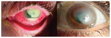 Contact Lens Related Pseudomonas Aeruginosa Keratitis In A 49 Year Old Woman Cmaj