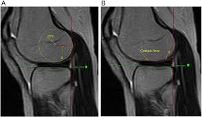 Assessing knee mri acl (anterior cruciate ligament) the anterior cruciate ligament (acl) originates from the medial aspect of the lateral femoral condyle, and inserts on the anterior. Upright Mri In Kinematic Assessment Of The Acl Deficient Knee The Knee