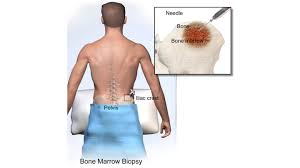 Image result for Bone Marrow Exam
