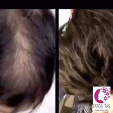Prp Sac Tedavisi Beauty Hacks Beauty