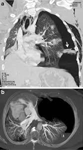 A pneumothorax is an abnormal collection of air in the pleural space between the lung and the chest wall. A B Tension Pneumothorax Indication For Immediate Chest Drainage A Download Scientific Diagram