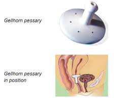 Image result for Pessary