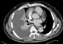 The pleural surface was normal, without pleural thickening or nodularity, in all three patients. Clinical Vignette 21 Miphidic