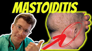 Image result for Mastoiditis
