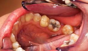The entire dental cavity filling process takes about an hour or so. Filling Trauma Study Finds Fillings Rotting Teeth Bite Magazine
