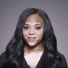 Cheri Lindsay Vitiligo Skin Model Vitiligo Model