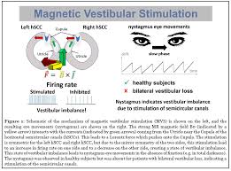 With reverse mechanical stimulation of the ossicles, the sound pressure distribution within the ear canal varies substantially, in narrow frequency. Welcome To Scientific Archives Comment On Modulatory Effects Of Magnetic Vestibular Stimulation On Resting State Networks Can Be Explained By Subject Specific Orientation Of Inner Ear Anatomy In The Mr Static Magnetic Field