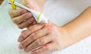 Diese Salben Helfen Bei Psoriasis Netdoktor At