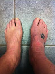 Pin On Complex Regional Pain Syndrome