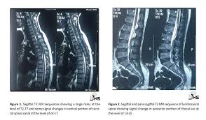 Spontaneous Spinal Epidural Hematoma In A Patient With A Prosthetic Valve Iranian Journal Of Neurosurgery