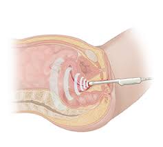 Since 2007, ultrasound dimensions has been trusted by over 100,000 patients and doctors. Pelvic Ultrasound Saint Luke S Health System