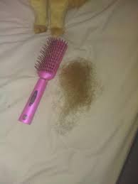 Hair loss and hair thinning can be devastating for both men and women. Losing This Amount Of Hair Every Couple Days Does Anybody Else Suffer With Hairloss Due To 6mp Crohnsdisease