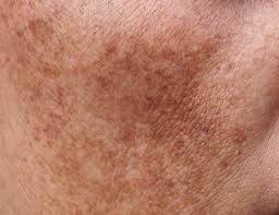 Image result for Melasma