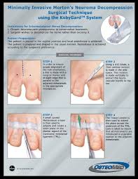 The neuroma consists of degenerative and fibrotic changes in the common digital nerve near its bifurcation. Minimally Invasive Morton S Neuroma Decompression Osteomed