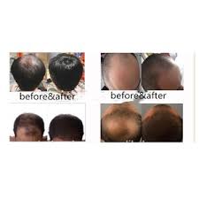 Free standard delivery order and collect. 2018 Best Selling Strong Version Pilatory Yuda Hair Growth Spray Hair Care Product Black Hair Care Product Guangzhou Jiayier Biological Technology Co Ltd Beautetrade