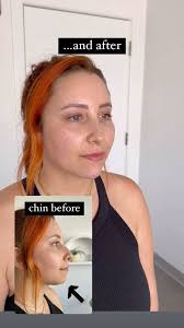 Facial balancing with chin and lip filler (lips already healed- chin filler  was next