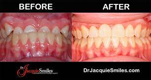 The first thing to consider is the type of orthodontic problem you're facing. Invisalign Clear Braces Treatment For An Underbite In Nycdr Jacquie