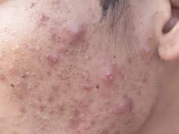 How long do blind pimples last. How To Get Rid Of Cystic Acne