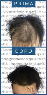 Punto luce a clip con stella cristallo 8 mm. Infoltimento Capelli Non Chirurgico Come Infoltire I Capelli La Tricopigmentazione Si Prende Cura Definitivamente Della Calvizie