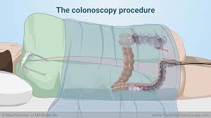 What Happens During And After A Colonoscopy Colonoscopy Colonoscopy Humor Medical Wallpaper