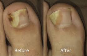 Patient right and left feet. Nail Fungus Treatment Cny Cosmetic Reconstructive Surgery Syracuse Ny