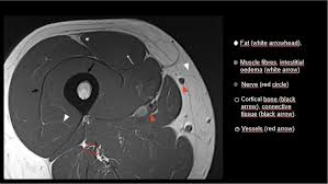 Anatomy of the knee can be complicated and hard to understand. A Beginners Guide To Musculoskeletal Mri Bjsm Blog Social Media S Leading Sem Voice
