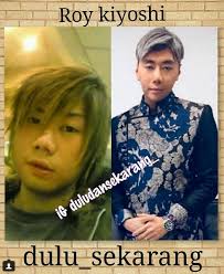 Before and after oplas roy kiyoshi. Hidung Palsu Roy Kiyoshi
