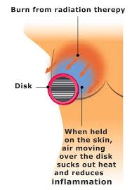 All Body Cancer Radiation Therapy Relief For Radiation Burns And Radiation Dermatitis Radiation Therapy Cancer Radiation Radiation Dermatitis