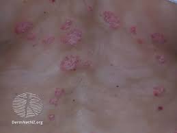 Image result for Keratosis pilaris