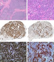 Primary Extranodal Nodular Lymphocyte Predominant Hodgkin Lymphoma Involving The Thyroid Springerlink