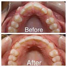 Orthodontic Before And After Pictures Wonderful Results With Braces At Amanda Gallagher Orthodontics Orthodontics Dental Braces After Braces