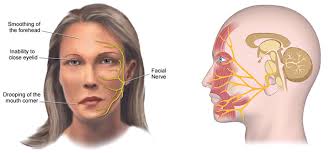 A person with bell's palsy can not wrinkle their forehead, but a person with a stroke can. Bell S Palsy Marou Pahati Sarne