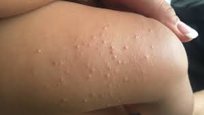 ما هي المليساء المعدية molluscum contagiosum ellearabia