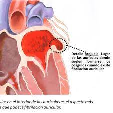 Universidad tecnica de oruro facultad de ciencias de la salud carrera de medicina expositora: Enfermedades Del Corazon
