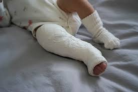 Image result for Clubfoot