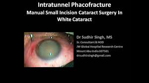 Intratunnel Phacofracture A New Msics Technique Eyewiki