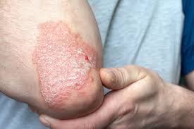 Image result for psoriasis