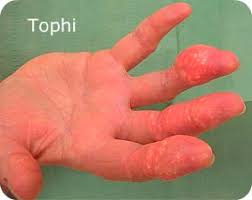 Read more about symptoms, diagnosis, treatment, complications the number of cells present in the corona and fibrovascular zones of the tophus was analyzed by. Tophi How You Know You Re A True Gout Veteran