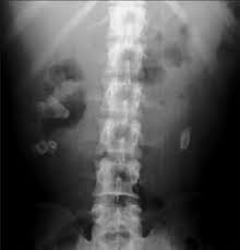 X Ray Kub Of A Patient With Bilateral Renal Stones Large Renal Shadows Download Scientific Diagram