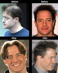 He is known for having starred in the mummy film series, and on the picture shown above, brendan is wearing thick & long curly hair in his movie, george of the jungle. Brendan Fraser Bald Before Hair Transplant Hair Transplant Before And After Hair Transplant Hair Transplant Results