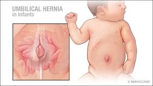 Image result for Inguinal hernia child