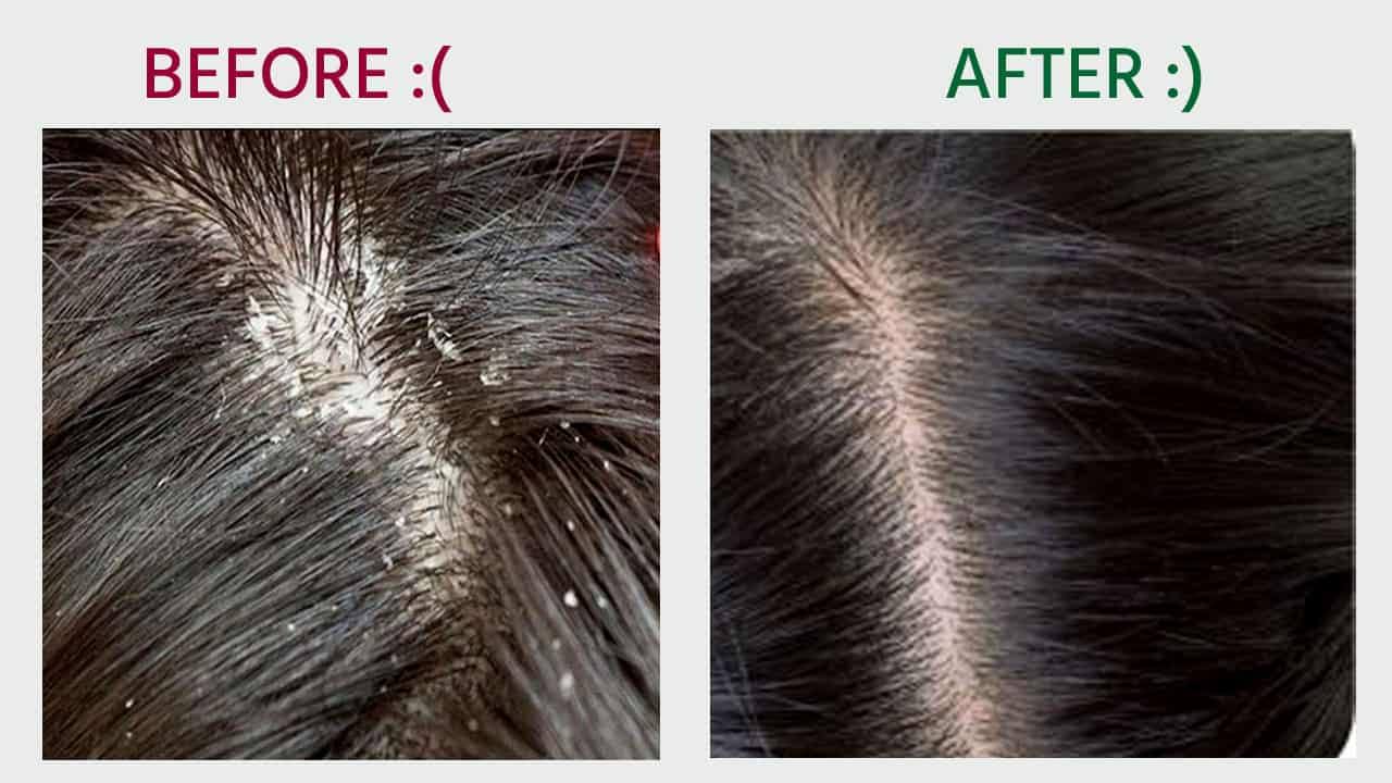 Dandruff treatment product image