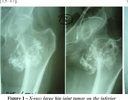 Image result for Chondrosarcoma