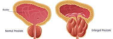Unfortunately, about 1 in 7 men will be diagnosed with prostate cancer in his lifetime. Is Drinking More Water The Answer To Your Bph Symptoms